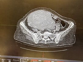 Uterine fibroid tumor