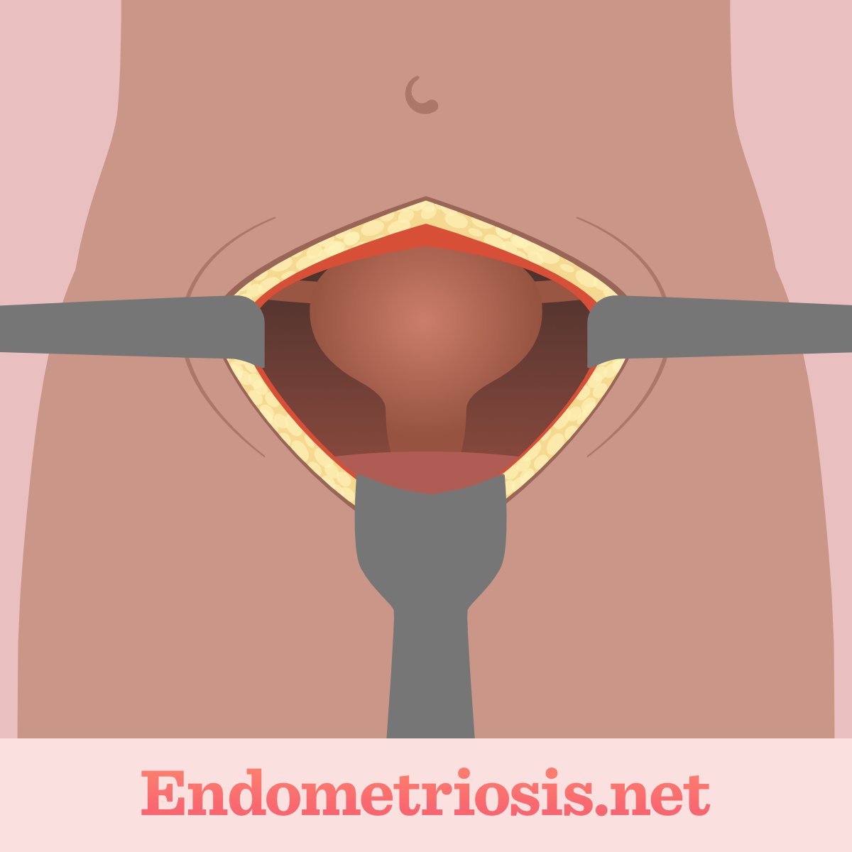 Surgeon performing laparotomy with surgical retractors through incision in lower abdomen to remove endometriosis from organs.