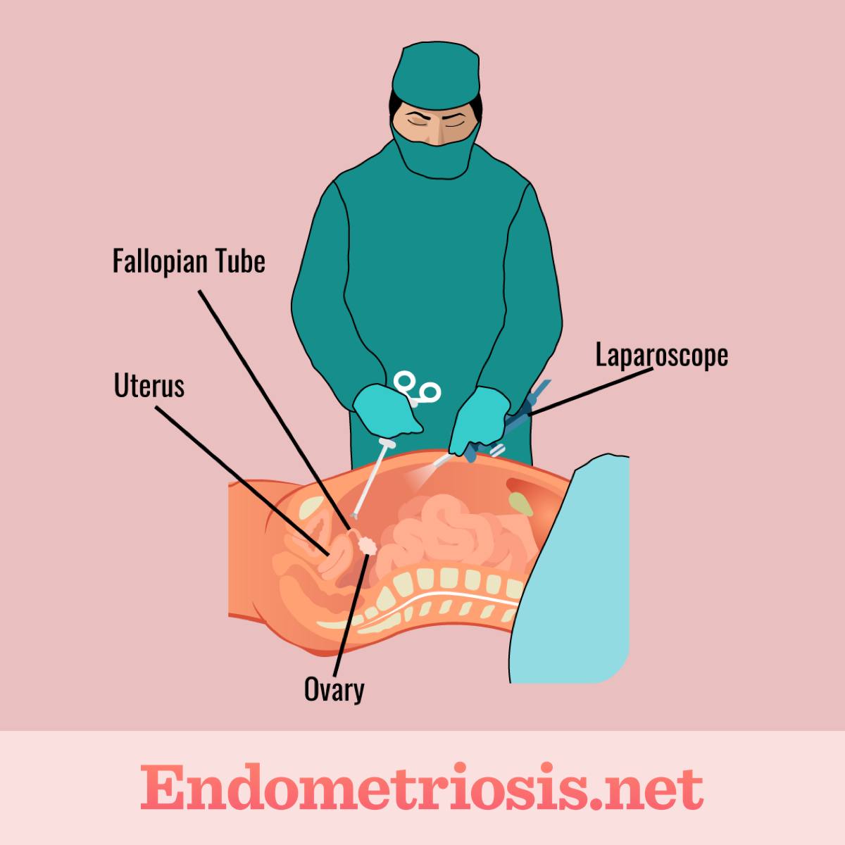 Surgeon performing laparoscopy through incision in abdomen to remove endometriosis from reproductive organs.