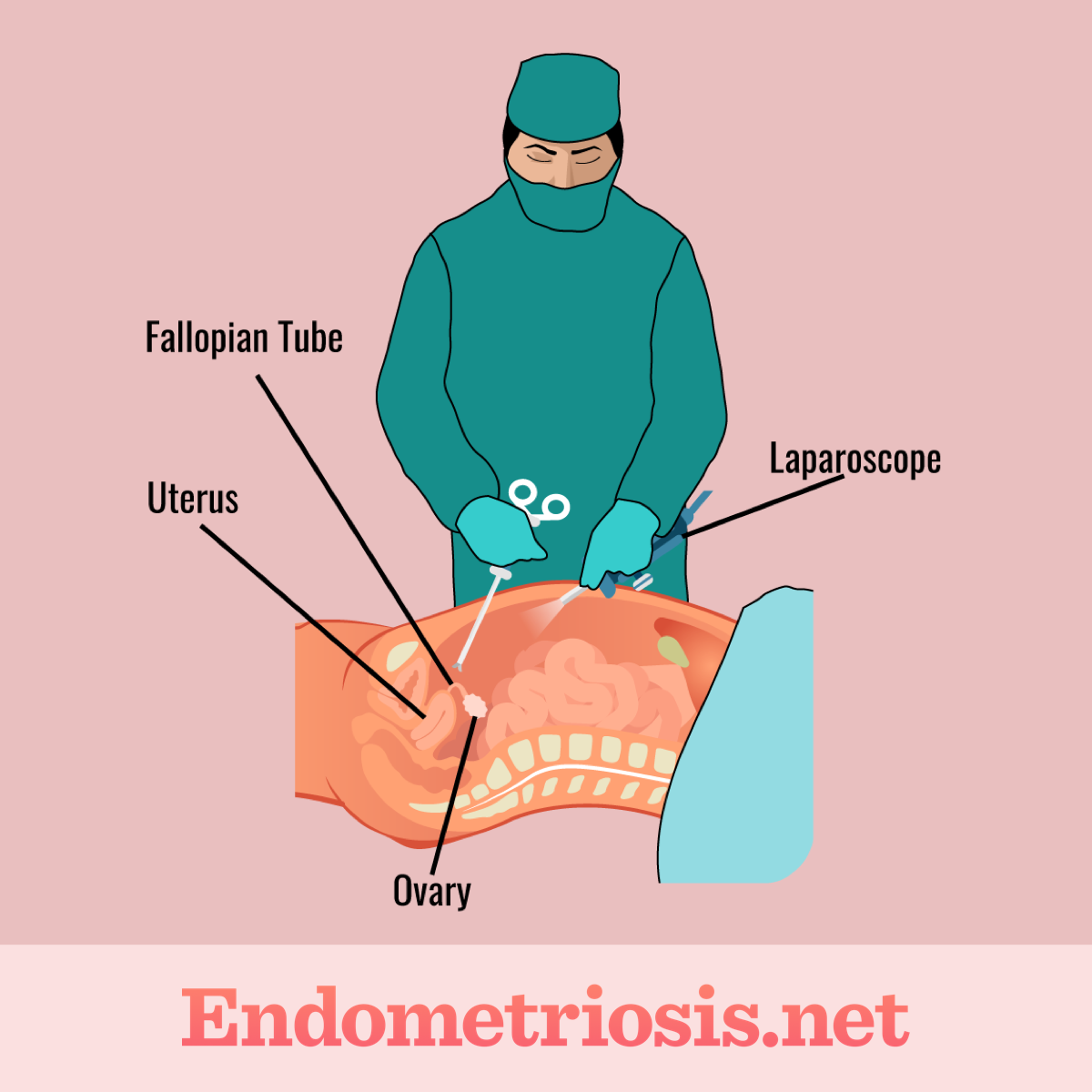 Laparoscopy Surgery for Endometriosis