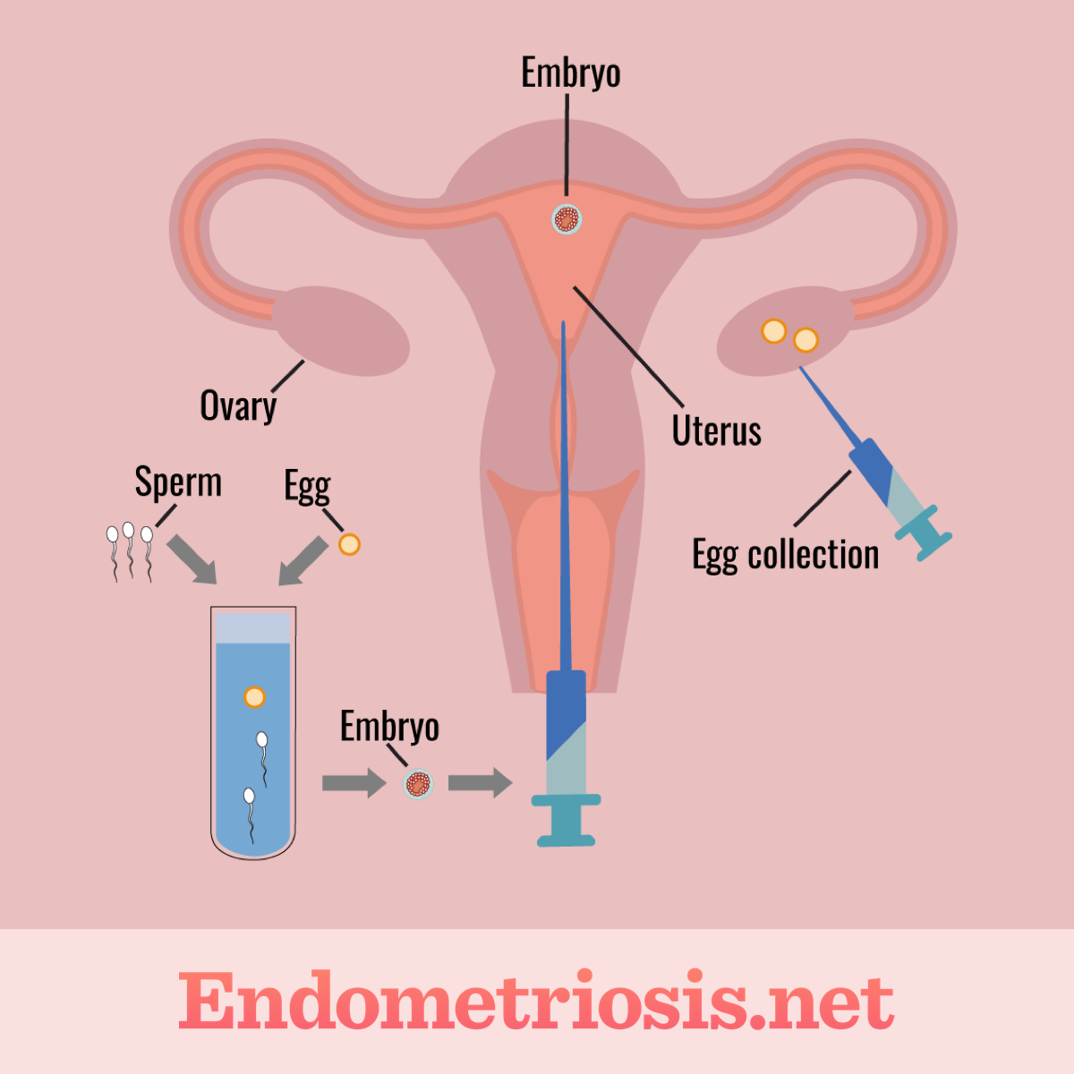 Egg retrieval from ovary using syringe and combining egg and sperm in a tube to create embryo transporting embryo back to uterus using large syringe