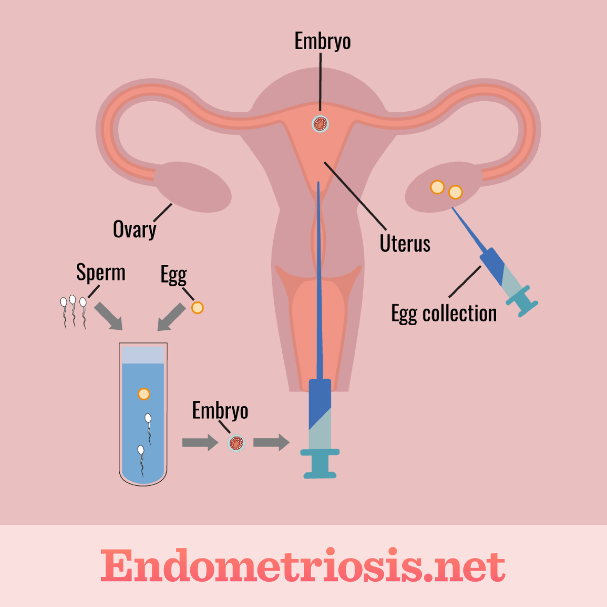 A diagram outlining the various IVF-related procedures, such as egg retrieval, combining egg and sperm, and insemination.