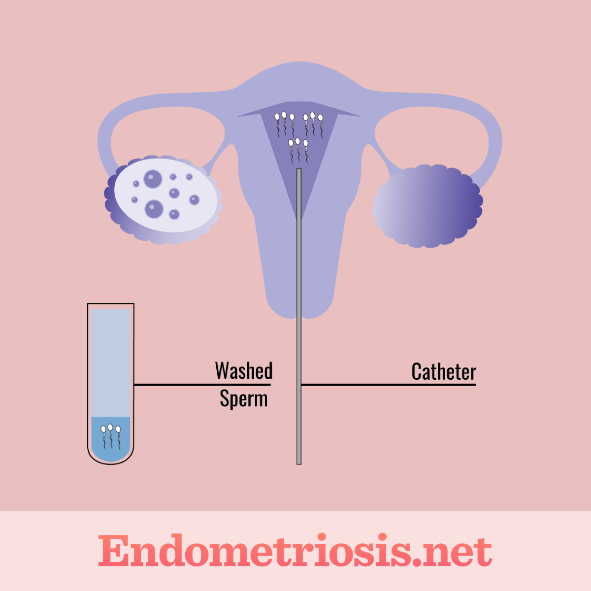 IUI procedure, where a catheter is inserted through vagina into uterus to insert washed sperm directly into uterus.