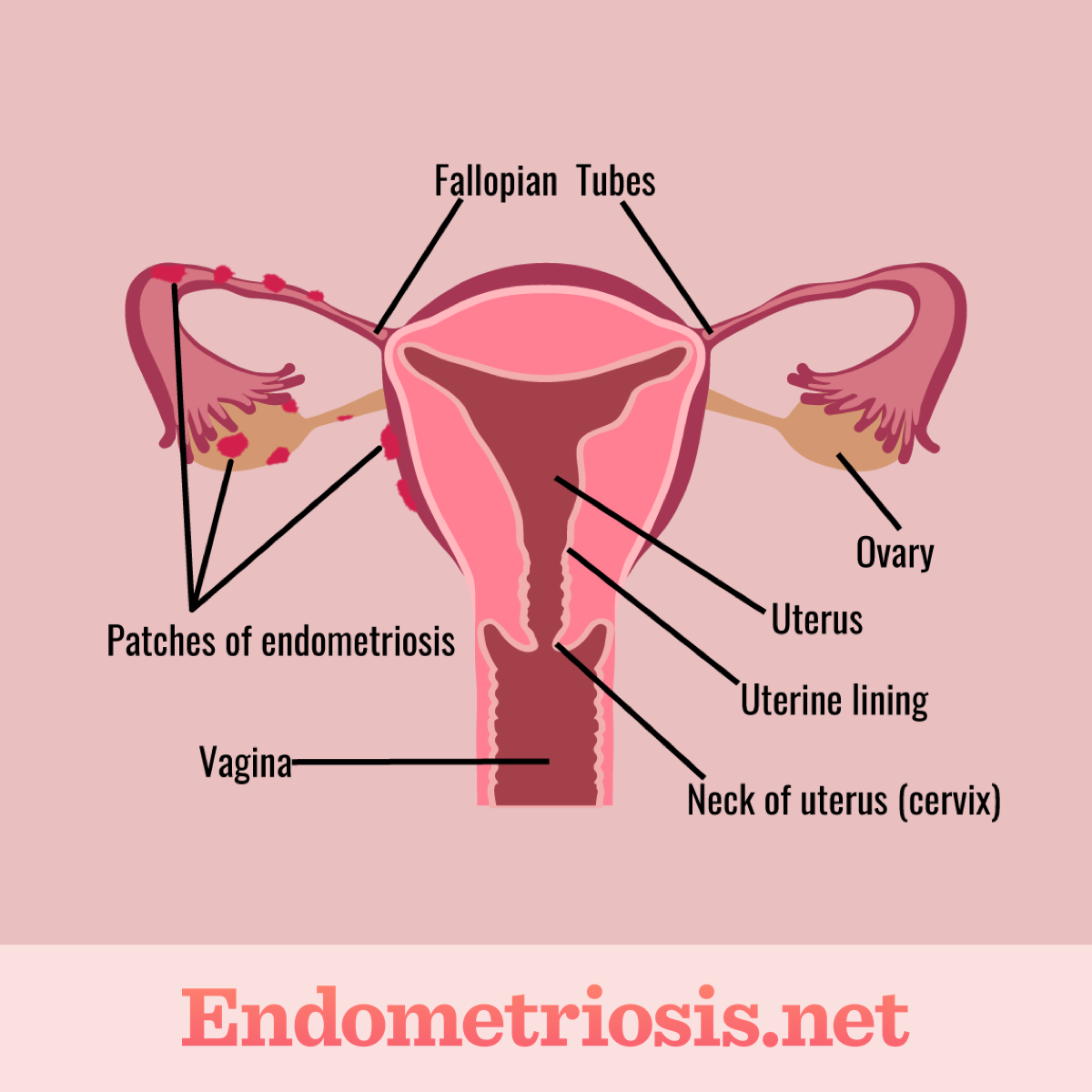 Female reproductive organs with patches of endometriosis lesions shown appearing on the ovaries and the fallopian tubes.