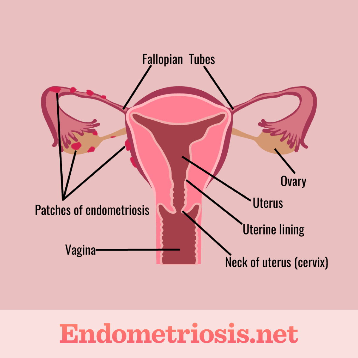 Female Reproductive Organs Affected by Endometriosis