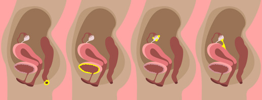 Dealing with The Complications of Endometriosis image