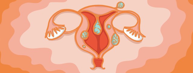 Uterine Fibroids and Endometriosis image