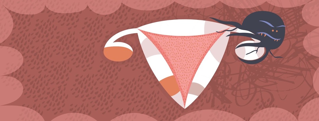 a uterus with an angry endometrioma