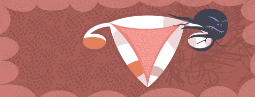 What is an Endometrioma? image
