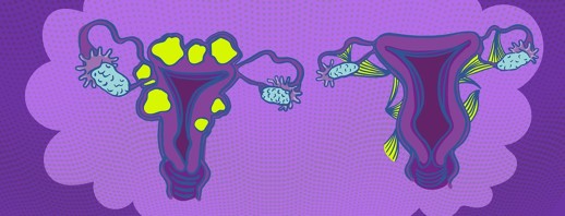 Uterine Fibroids versus Endometriosis: What’s the Difference? image
