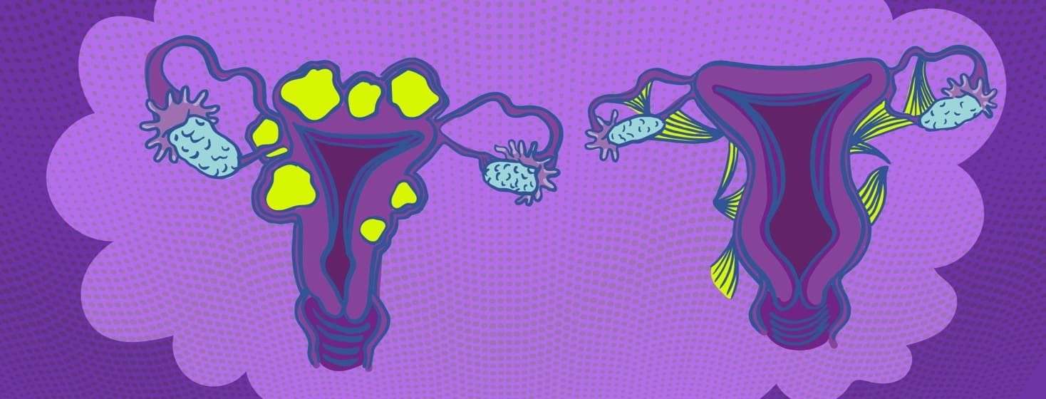 Uterine Fibroids Versus Endometriosis What’s The Difference.