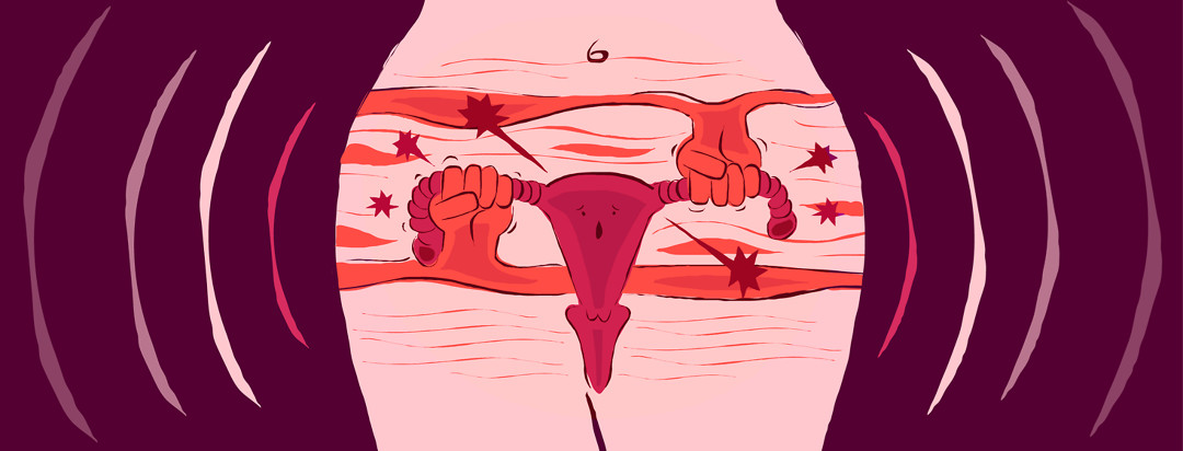 Two fists are springing out of the muscles of a woman's pelvic region to to squeeze her groin, with her uterus not looking too happy about it