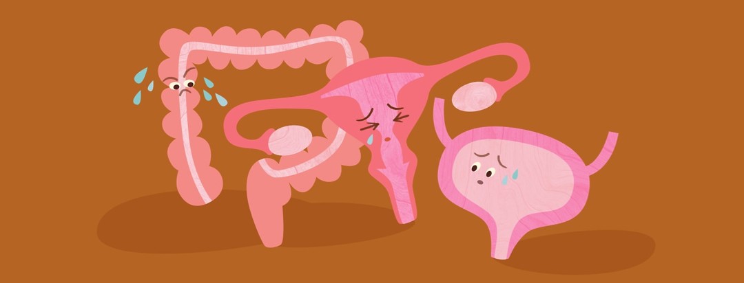Tipped uterus leaning on an angry looking colon while a concerned bladder looks on
