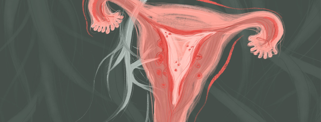 A pelvic anatomy is featured in the foreground, with an "empty" artery flowing to the spots of adeno on the uterus.
