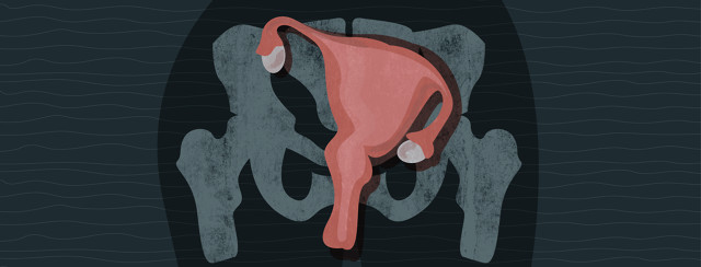 Why A Displaced Uterus Might Be Causing Me Pain image