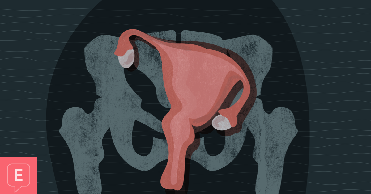 Endometriosis Uterus Displaced Pain.