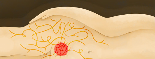 Hip Pain and Endometriosis image