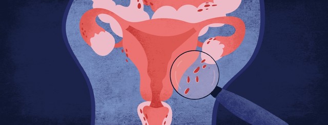 Deep Infiltrating Endometriosis: Rare or Just Underdiagnosed? image