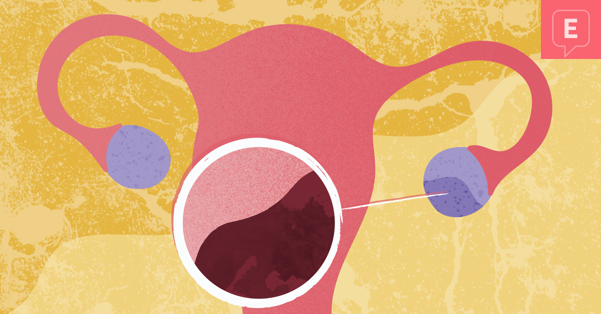 Looking at Cystic Ovarian Endometriosis: What are Endometriomas?