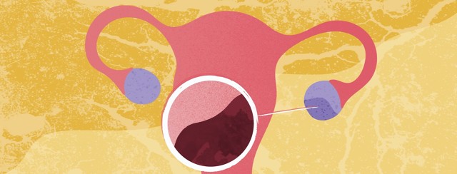 Looking at Cystic Ovarian Endometriosis: What are Endometriomas? image