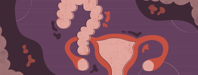 The Link Between IBS, SIBO and Endometriosis image