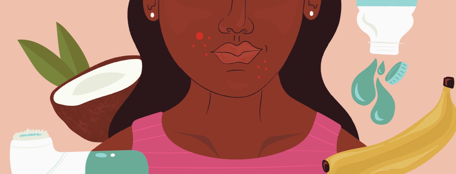 10 Ways To Fight Acne | Endometriosis.net