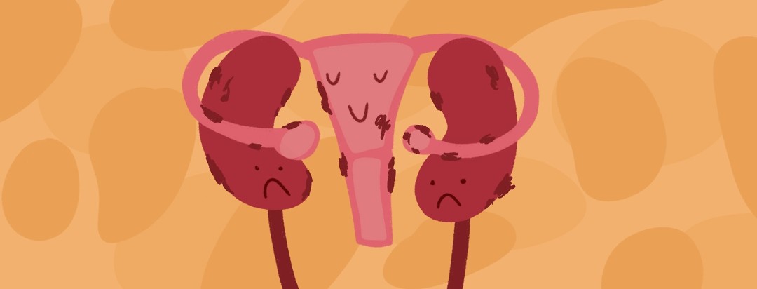 A uterus with endometriosis tightly hugs two kidneys who are also covered in endometrial tissue