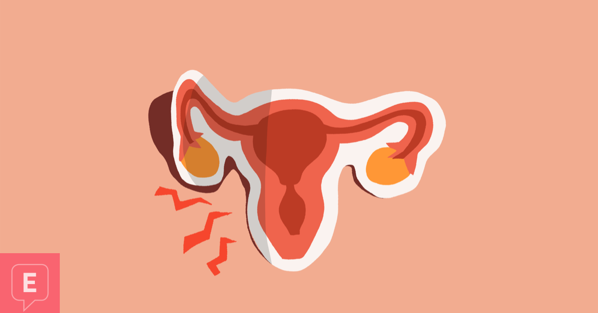 Recurring Endometriosis Post-Hysterectomy