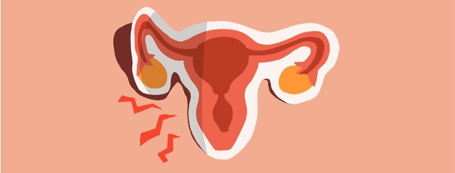 Recurring Endometriosis Post-Hysterectomy image