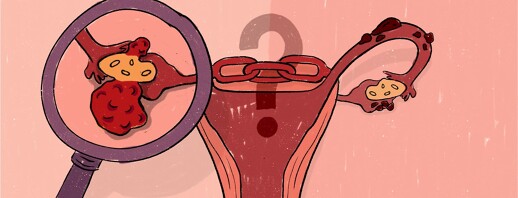 Are Ovarian Cancer and Endometriosis Linked? image