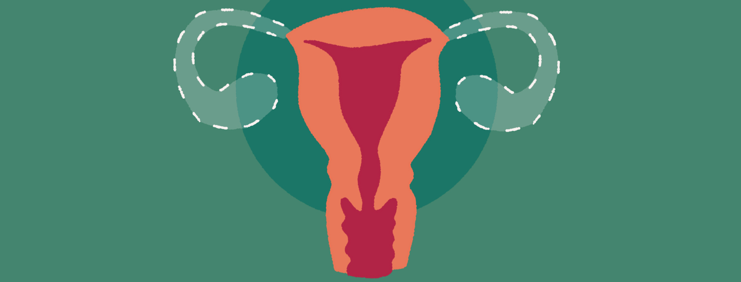 A uterus with the ovaries shown to be missing with a dotted outline